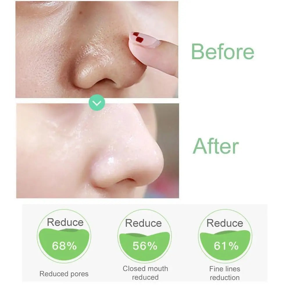 Salicylate Shrink Pores To Remove Blackheads And Repair Acne Marks - Beuti-Ful