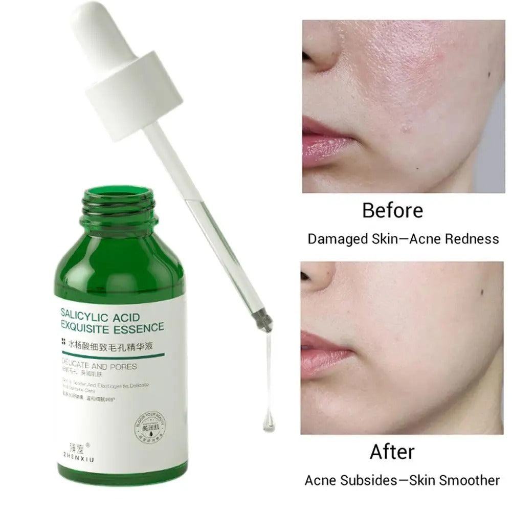 Salicylate Shrink Pores To Remove Blackheads And Repair Acne Marks