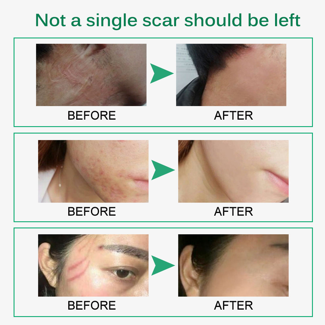 Skin Rebound Scarless Cream Scar Removal Cream Face Cream For Face Acne Scar Stretch Marks Skin Repair Face Cream - Beuti-Ful