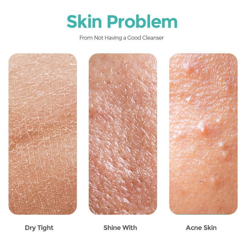 Salicylate Acne Cleanser Hydrating And Cleaning - Beuti-Ful